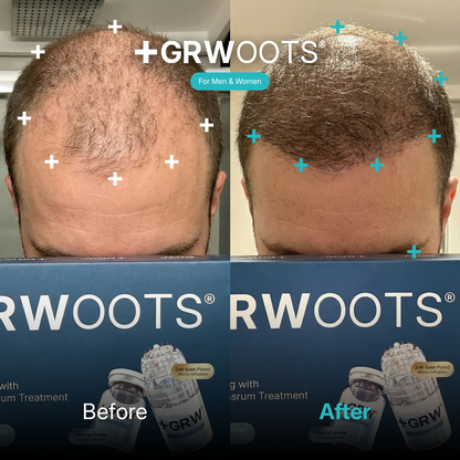 GRWOOTS® Micro-Infusion Hair Growth Treatment