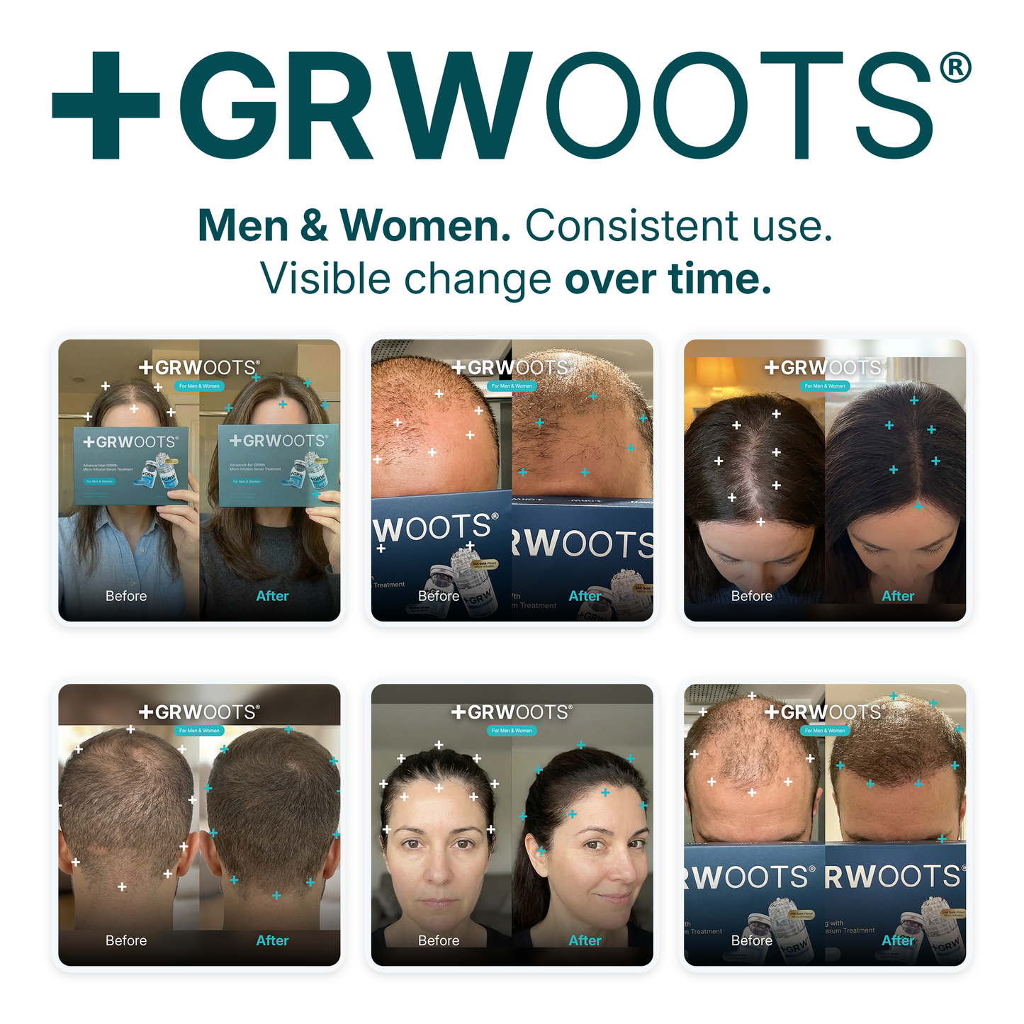 GRWOOTS® Micro-Infusion Hair Growth Treatment