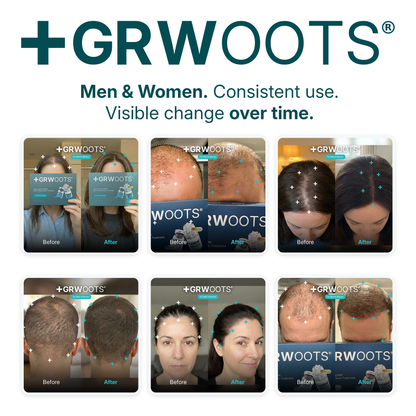 GRWOOTS® Micro-Infusion Hair Growth Treatment